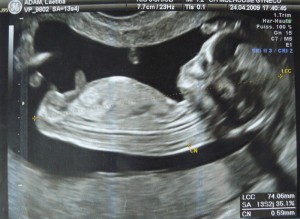 un beau foetus de 3 mois